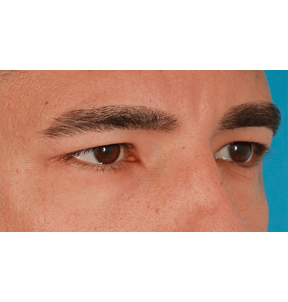 Upper Blepharoplasty Before & After Patient #2645