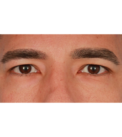 Upper Blepharoplasty Before & After Patient #2645
