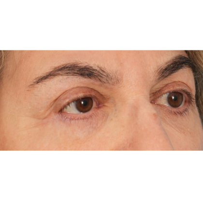 Lower Blepharoplasty Before & After Patient #2674