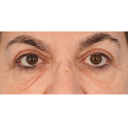 Lower Blepharoplasty Before & After Patient #2674