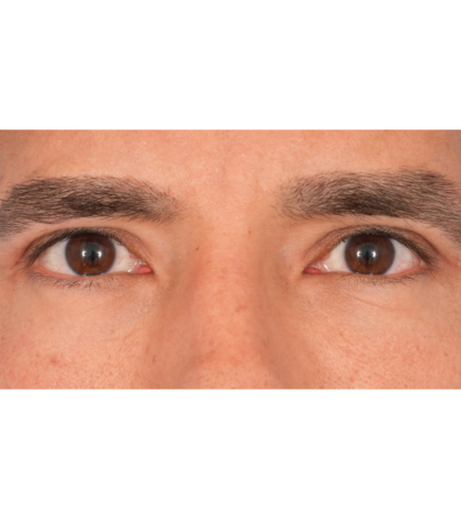 Upper Blepharoplasty Before & After Patient #2645