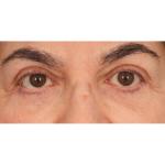 Lower Blepharoplasty Before & After Patient #2674