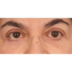 Lower Blepharoplasty Before & After Patient #2674