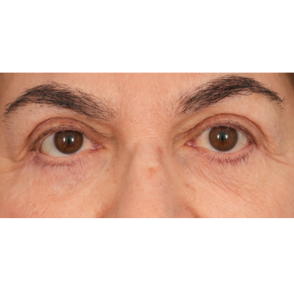 Lower Blepharoplasty Before & After Patient #2674