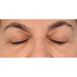 Lower Blepharoplasty Before & After Patient #2674