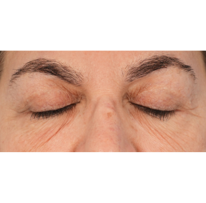 Lower Blepharoplasty Before & After Patient #2674