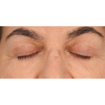 Lower Blepharoplasty Before & After Patient #2674