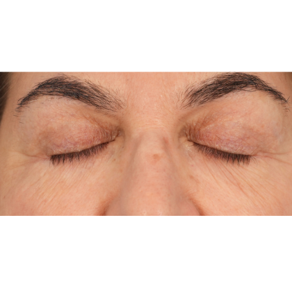 Lower Blepharoplasty Before & After Patient #2674