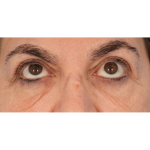 Lower Blepharoplasty Before & After Patient #2674