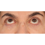 Lower Blepharoplasty Before & After Patient #2674