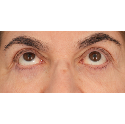 Lower Blepharoplasty Before & After Patient #2674