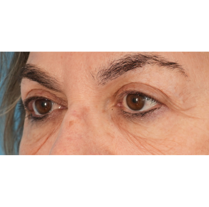 Lower Blepharoplasty Before & After Patient #2674