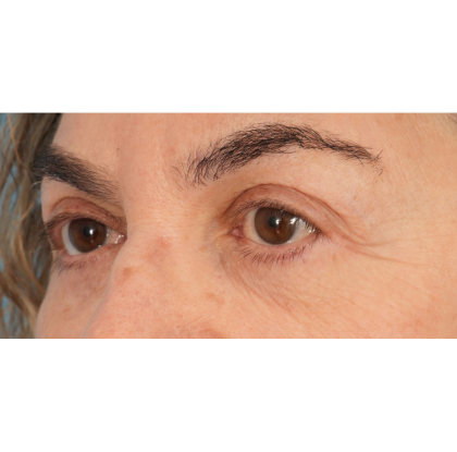 Lower Blepharoplasty Before & After Patient #2674