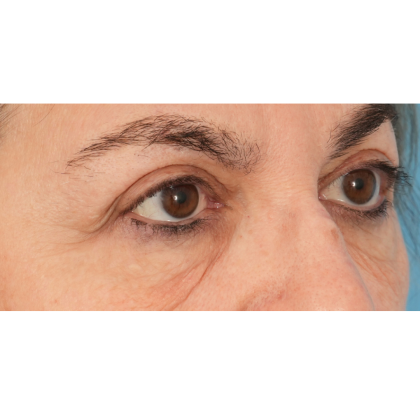 Lower Blepharoplasty Before & After Patient #2674