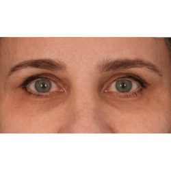 Fat Grafting Before & After Patient #2740