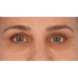 Fat Grafting Before & After Patient #2740