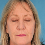 CO2 Laser Resurfacing Before & After Patient #2719