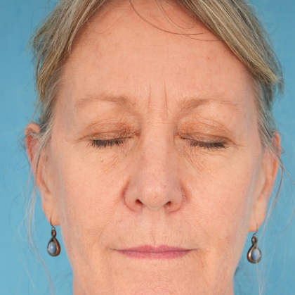 CO2 Laser Resurfacing Before & After Patient #2719