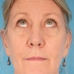 CO2 Laser Resurfacing Before & After Patient #2719