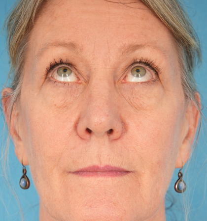 CO2 Laser Resurfacing Before & After Patient #2719