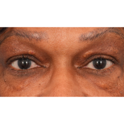 Quad Blepharoplasty Before & After Patient #2775