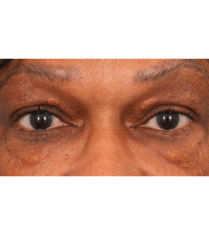 Quad Blepharoplasty Before & After Patient #2775