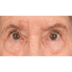 Lower Blepharoplasty Before & After Patient #2764