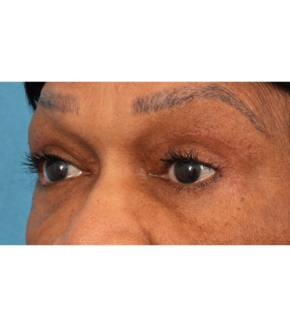 Quad Blepharoplasty Before & After Patient #2775