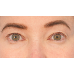 Upper Blepharoplasty Before & After Patient #2859