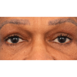 Quad Blepharoplasty Before & After Patient #2775