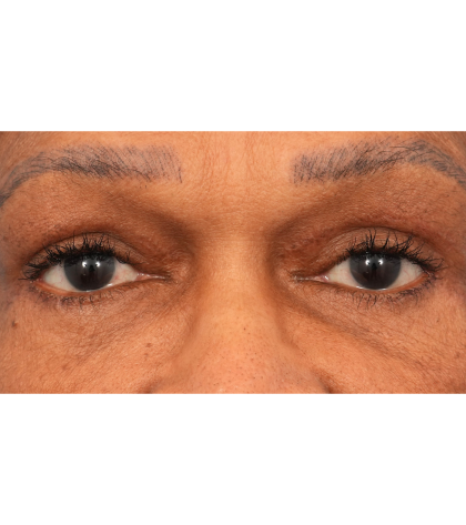 Quad Blepharoplasty Before & After Patient #2775