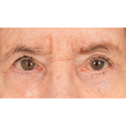 Lower Blepharoplasty Before & After Patient #2764