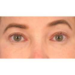 Upper Blepharoplasty Before & After Patient #2859