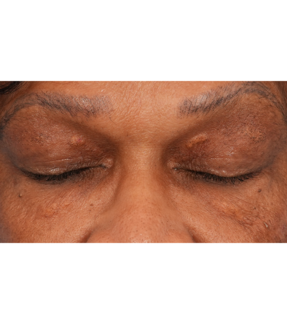 Quad Blepharoplasty Before & After Patient #2775