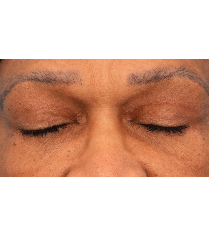 Quad Blepharoplasty Before & After Patient #2775