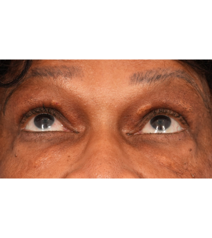 Quad Blepharoplasty Before & After Patient #2775