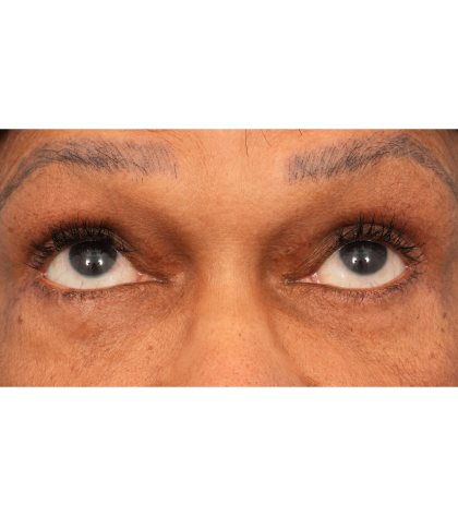 Quad Blepharoplasty Before & After Patient #2775