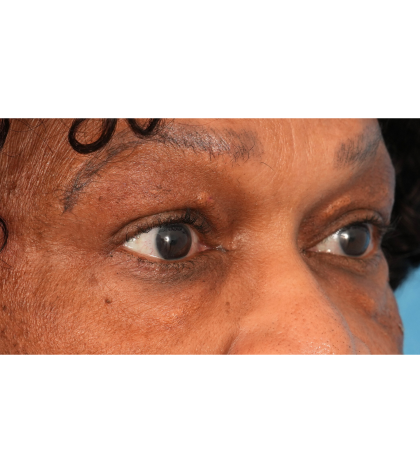 Quad Blepharoplasty Before & After Patient #2775