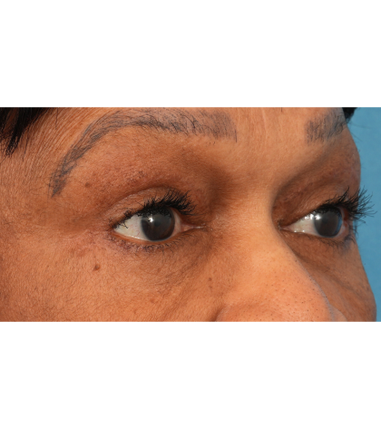 Quad Blepharoplasty Before & After Patient #2775