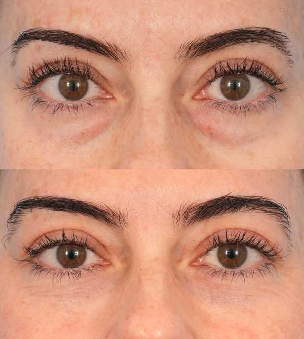 Eyelid Bags