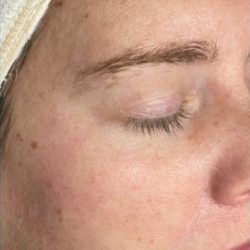 Skinpen Before & After Patient #2888