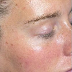 Skinpen Before & After Patient #2888