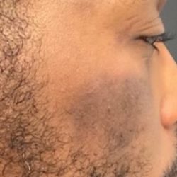 Skinpen Before & After Patient #2889