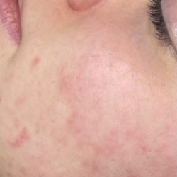 Skinpen Before & After Patient #2890