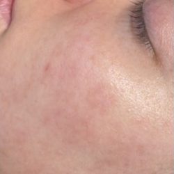 Skinpen Before & After Patient #2890