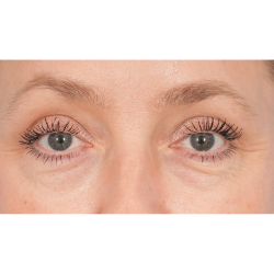 Lower Blepharoplasty Before & After Patient #2939