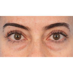 Lower Blepharoplasty Before & After Patient #2911