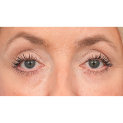 Lower Blepharoplasty Before & After Patient #2939