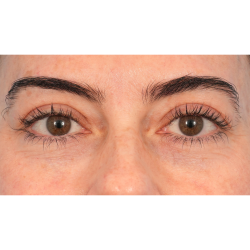 Lower Blepharoplasty Before & After Patient #2911