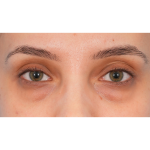 IPL (Intense Pulsed Light) Before & After Patient #2972